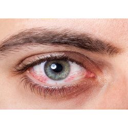 Herpes Simplex Eye Infections